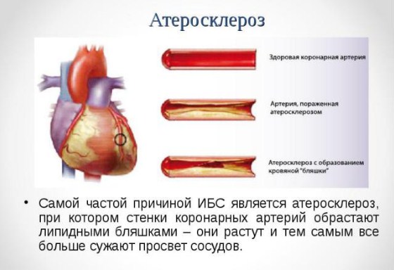 Золотым стандартом в диагностике атеросклероза коронарных артерий thumbnail